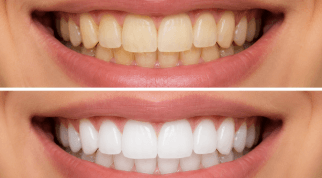 Teeth Whitening​